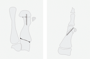 Der Hallux valgus oder Ballenzeh ist eine der häufigsten Fußdeformitäten überhaupt. Ist eine sichtbare Fehlstellung der Großzehe erst eingetreten, lässt sie sich oft nur noch durch eine Operation korrigieren.