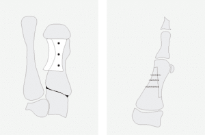 Der Hallux valgus oder Ballenzeh ist eine der häufigsten Fußdeformitäten überhaupt. Ist eine sichtbare Fehlstellung der Großzehe erst eingetreten, lässt sie sich oft nur noch durch eine Operation korrigieren.