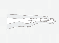Hammerzeh vor der OP - ARS PEDIS