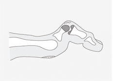 Hammerzeh vor der OP - ARS PEDIS