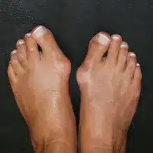 Der Hallux valgus oder Ballenzeh ist eine der häufigsten Fußdeformitäten überhaupt. Ist eine sichtbare Fehlstellung der Großzehe erst eingetreten, lässt sie sich oft nur noch durch eine Operation korrigieren.