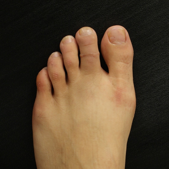 Zehenverkürzung - meist ist der zweite Zeh betroffen.